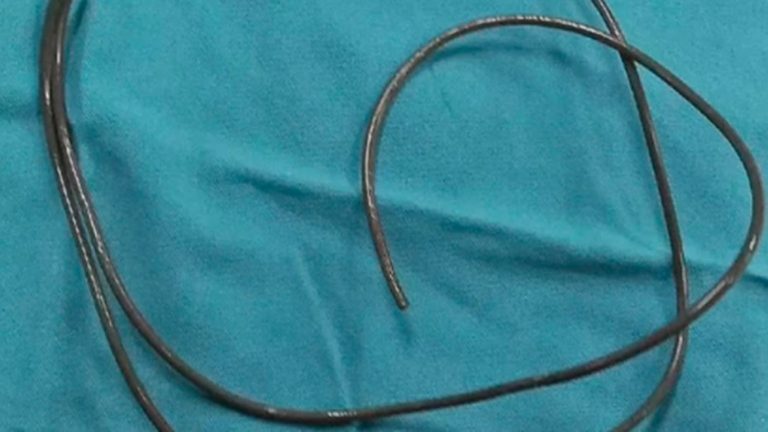 Lee más sobre el artículo No podía orinar y lo que encontraron en su vejiga sorprendió a los médicos: “Lo hacía por placer sexual”