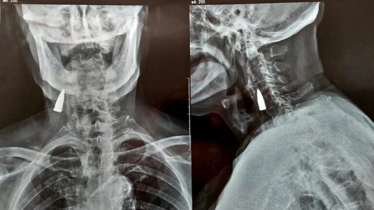 Lee más sobre el artículo Tras sufrir una caída en su balcón, fue al hospital y descubrieron que tenía una bala en el cuello