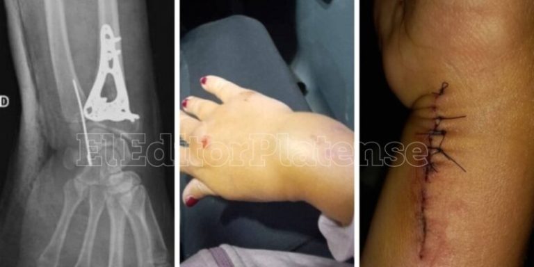 Lee más sobre el artículo Brutal asalto: le fracturaron la muñeca para robarle la bici