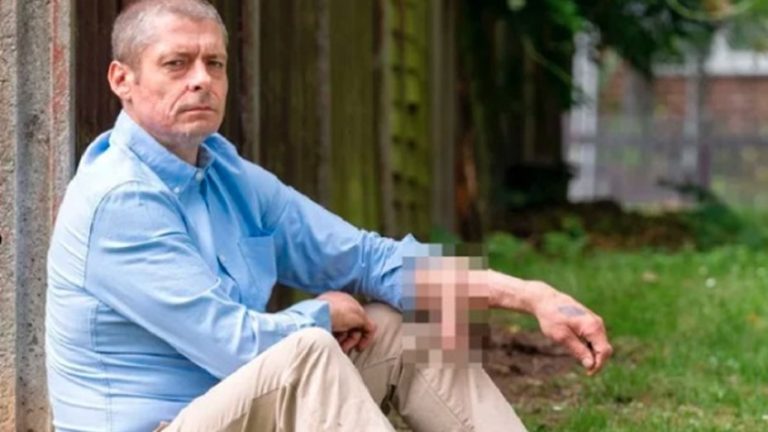 Lee más sobre el artículo Vivió 6 años con un injerto de pene en el brazo y ahora se lo ubicaron en el lugar correcto