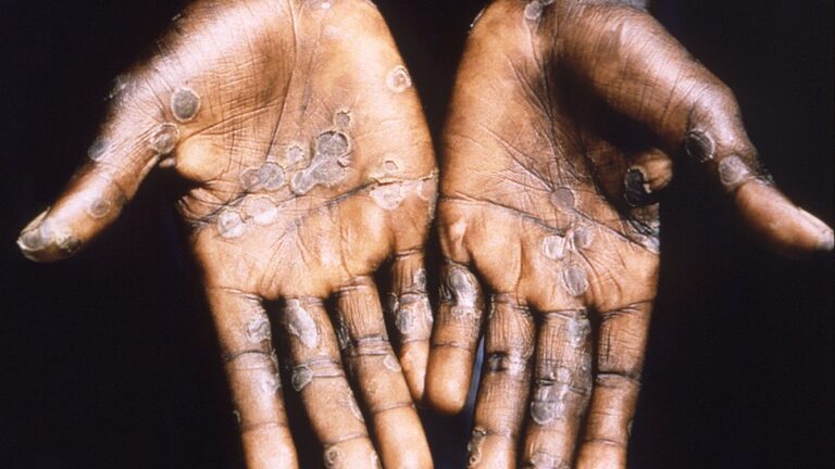 Lee más sobre el artículo Confirmaron la primera muerte por viruela símica en la Argentina