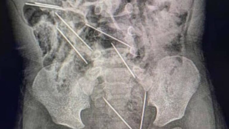 Lee más sobre el artículo Llevó a su hijo de 2 años con fuertes dolores al hospital y tuvieron que operarlo de urgencia por lo que se había tragado