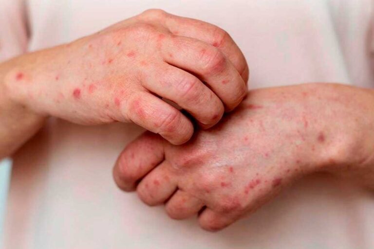Lee más sobre el artículo “Viruela símica en Argentina: el Ministerio de Salud emite nuevas recomendaciones para prevenir contagios”