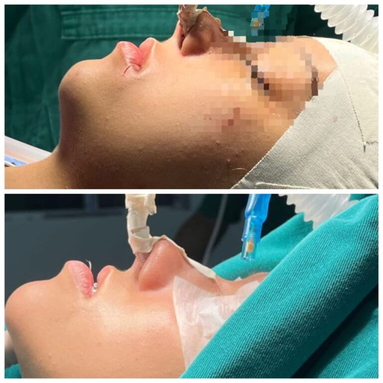 Lee más sobre el artículo El Hospital Central realizó la primera cirugía ortognática en la provincia